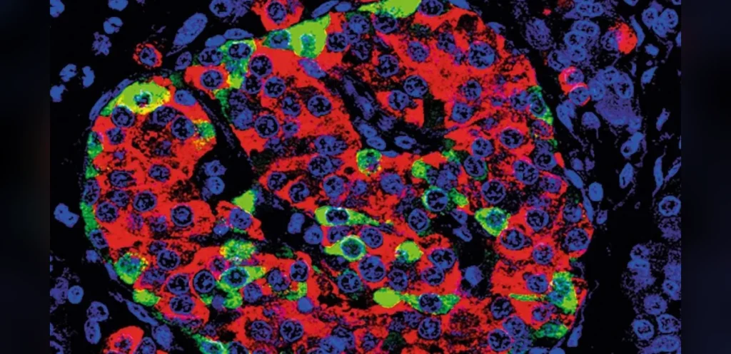 Clinical Trials Show Stem Cell Therapy May Restore Insulin Production in Type 1 Diabetes