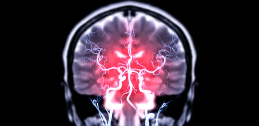 Study Connects Specific Hormonal Contraceptives to Elevated Meningioma Risk