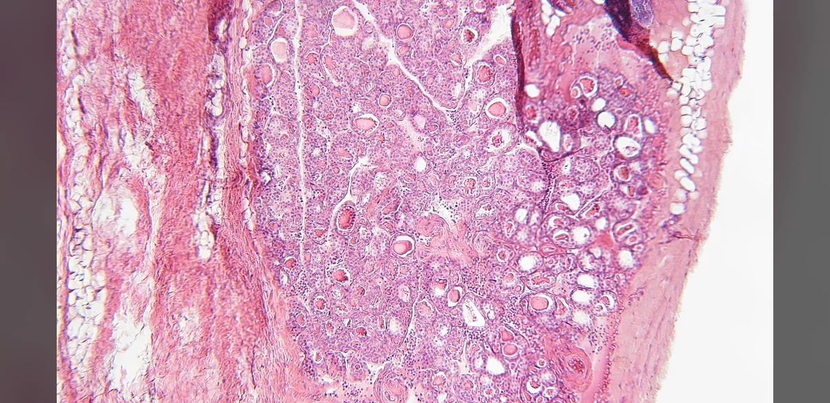 Research Examines Muscle Loss Impact on Diabetic Foot Patient Results