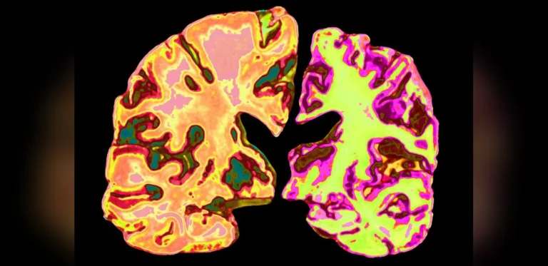 Investigating Low-Dose Lithium for Alzheimer’s Prevention