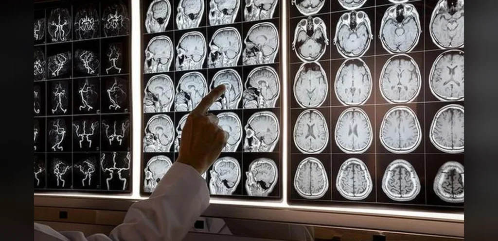 Health Wrap Episode 56 discusses early-onset Alzheimer’s, cancer research paper mills and more